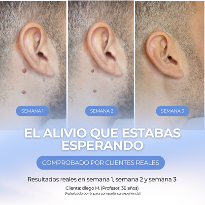 WARTIX REMOVER™ - Elimina verrugas y lunares al instante