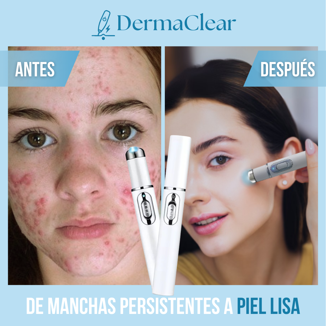 Dermaclear™ - Elimina imperfecciones al instante