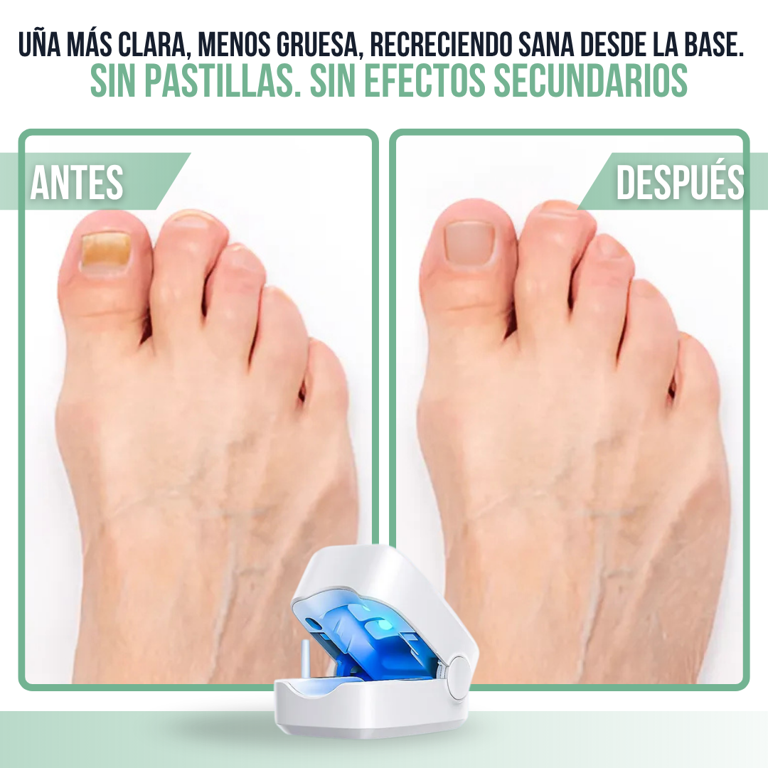 OrthoVital™ Dispositivo de Luz Azul para Hongos en Uñas | Las Cremas No Llegan al Hongo.